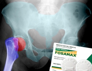 femurfracture2_Fosamax